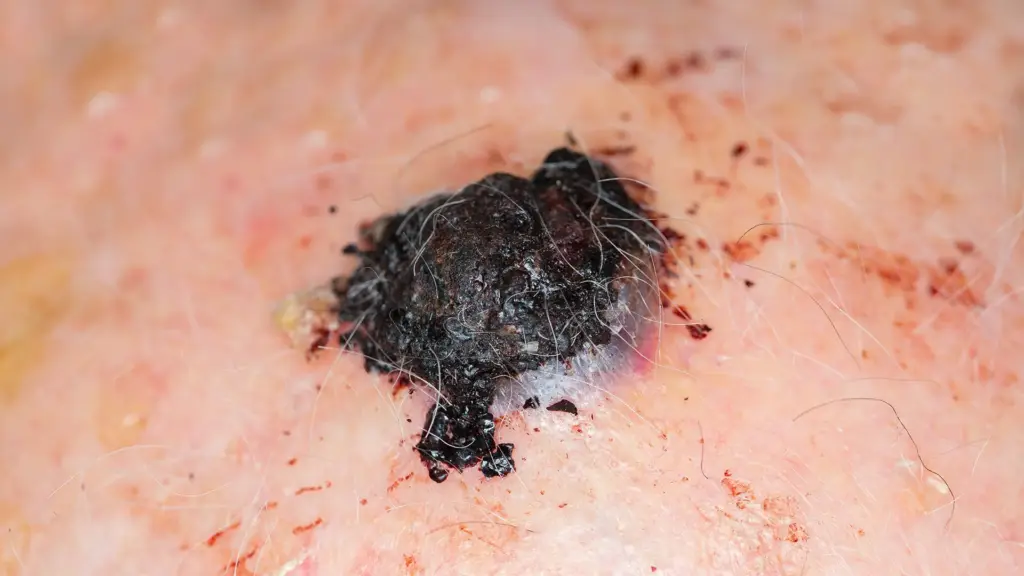 悪性黒色腫（メラノーマ）