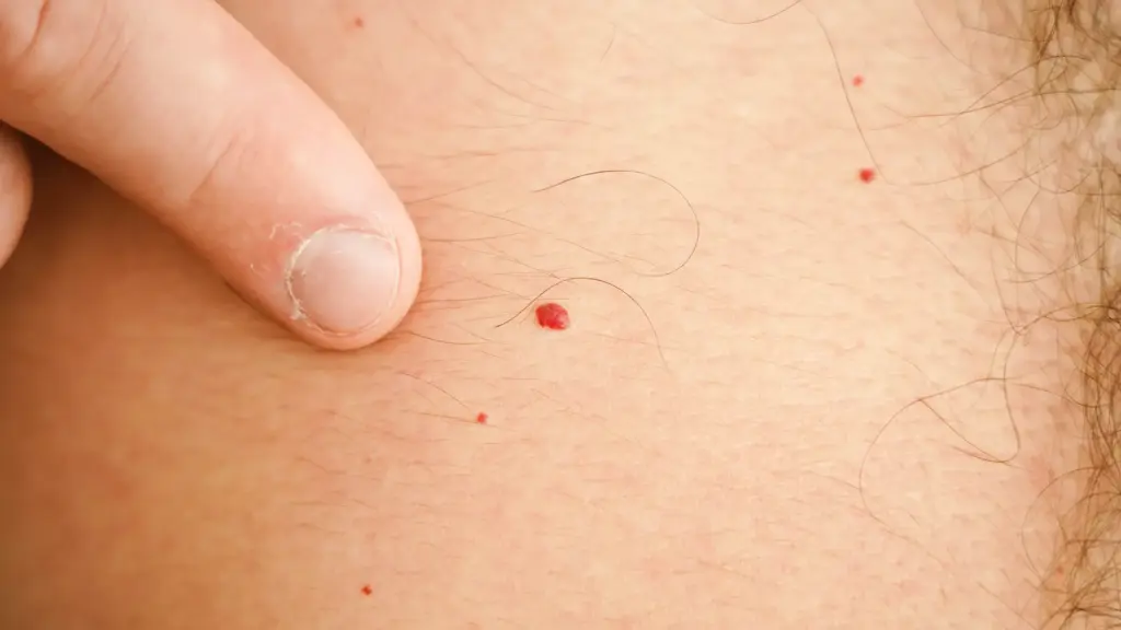 赤い ほくろ