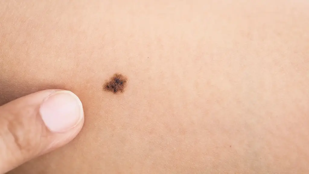 ほくろ