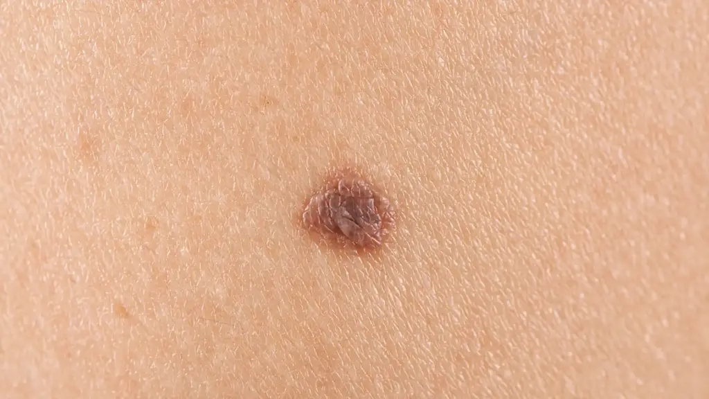 ほくろ