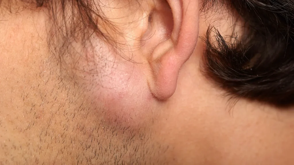 顔にできた脂肪腫