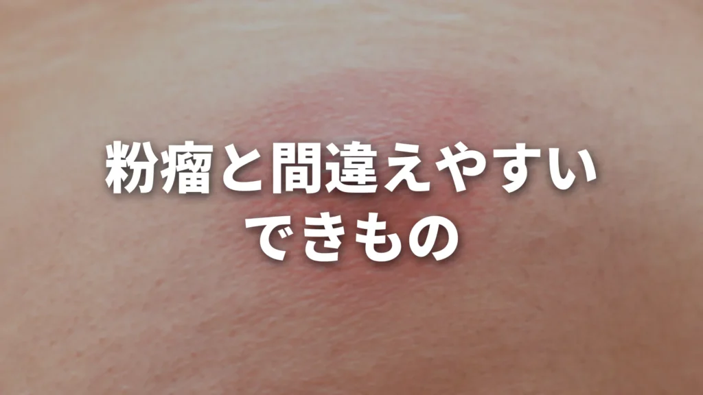 粉瘤と間違えやすいできもの｜毛嚢炎・おでき・硬いしこりとの違いを専門医が解説